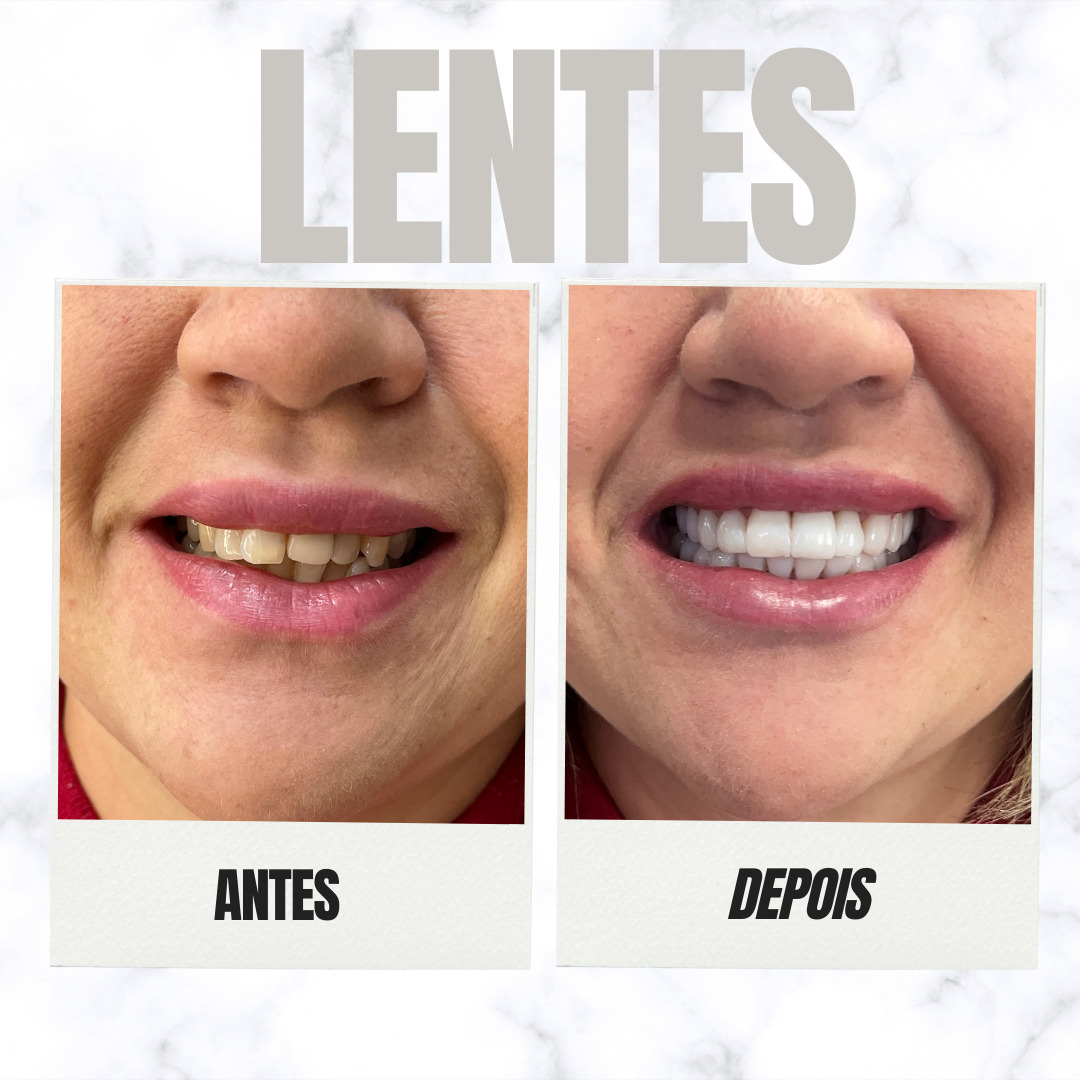 lentes - 1