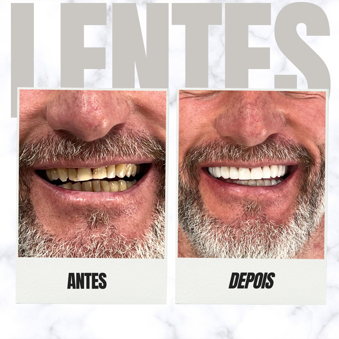 lentes - 17