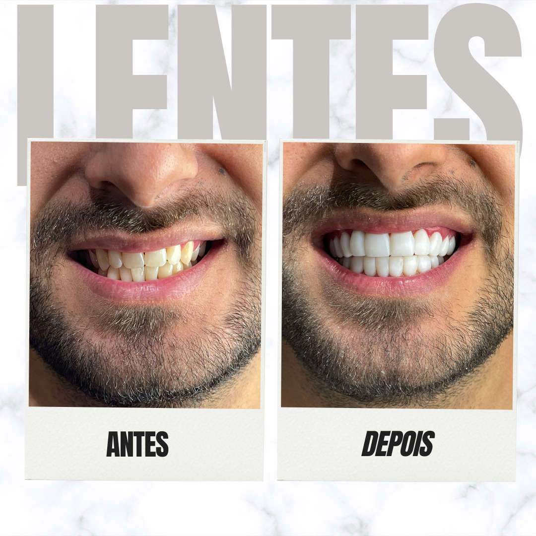 lentes - 36