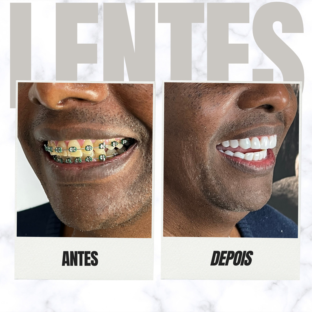 lentes - 9